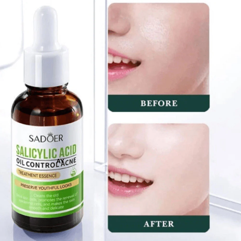 Sadoer Salicylic Acid Oil Control Acne Treatment Essence 30ml - Image 3